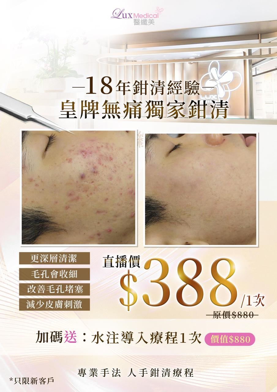 【直播價】皇牌無痛獨家鉗清療程 1次（送水注導入療程1次）